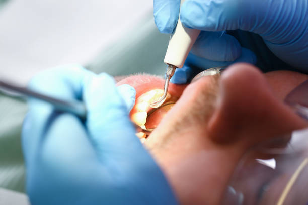 Best Emergency Treatment for Dental Infections or Abscesses in Hayward, WI